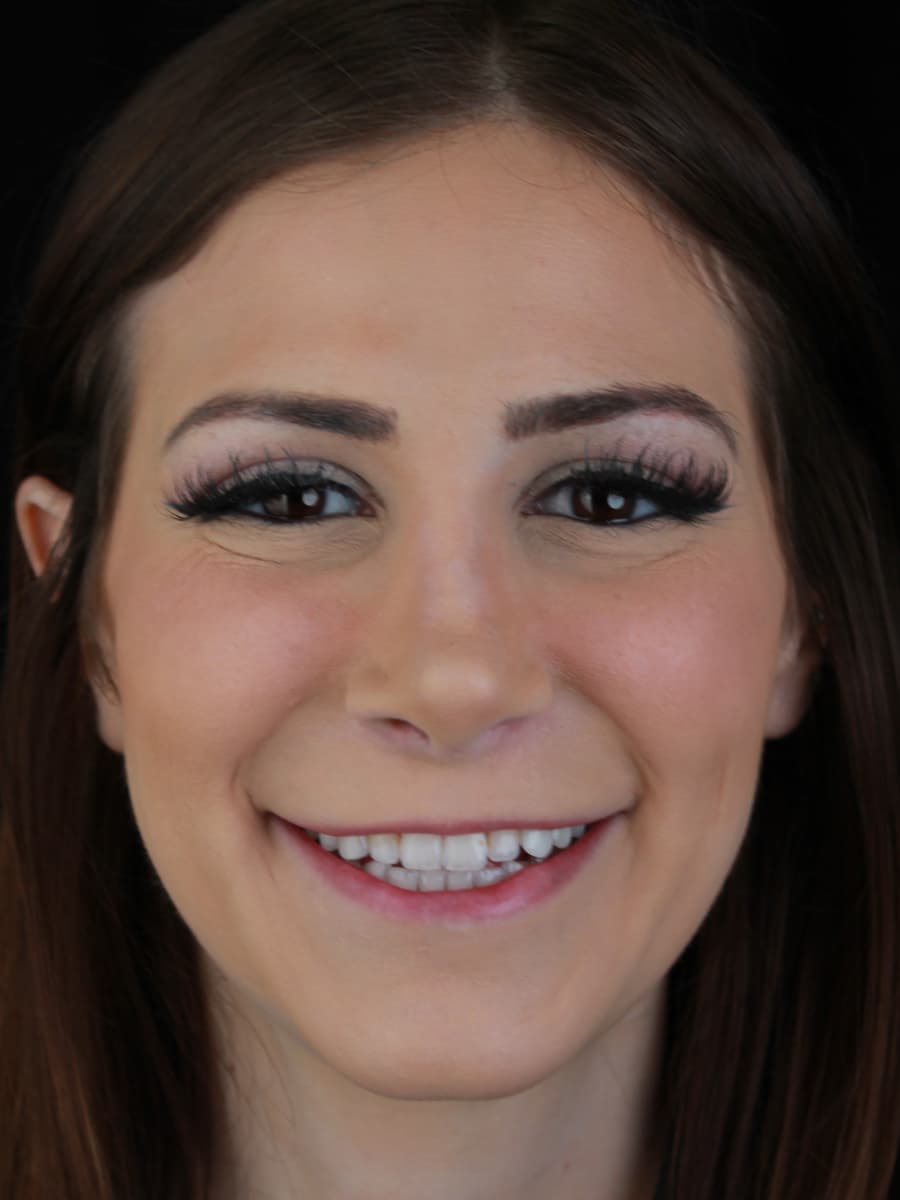 Erielle — veneer result 2