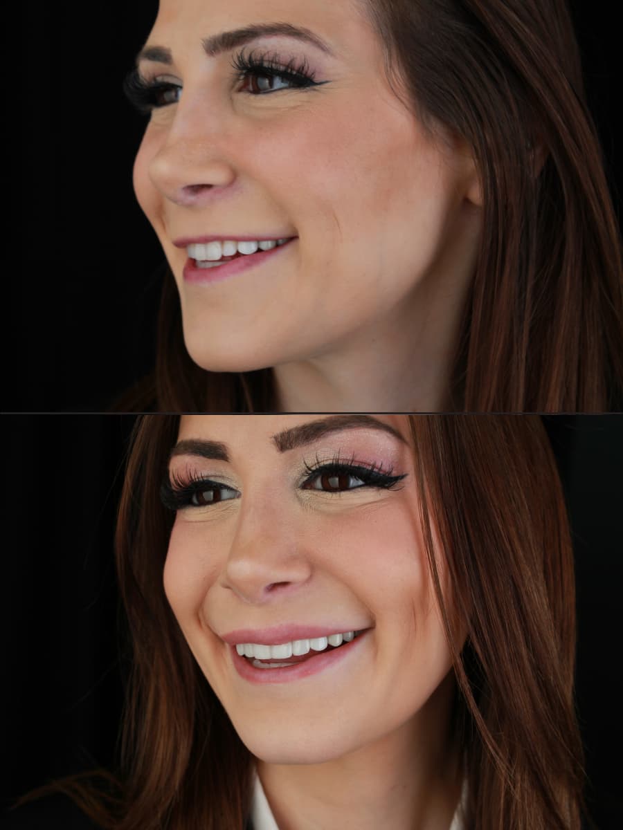 Erielle — veneer result 3