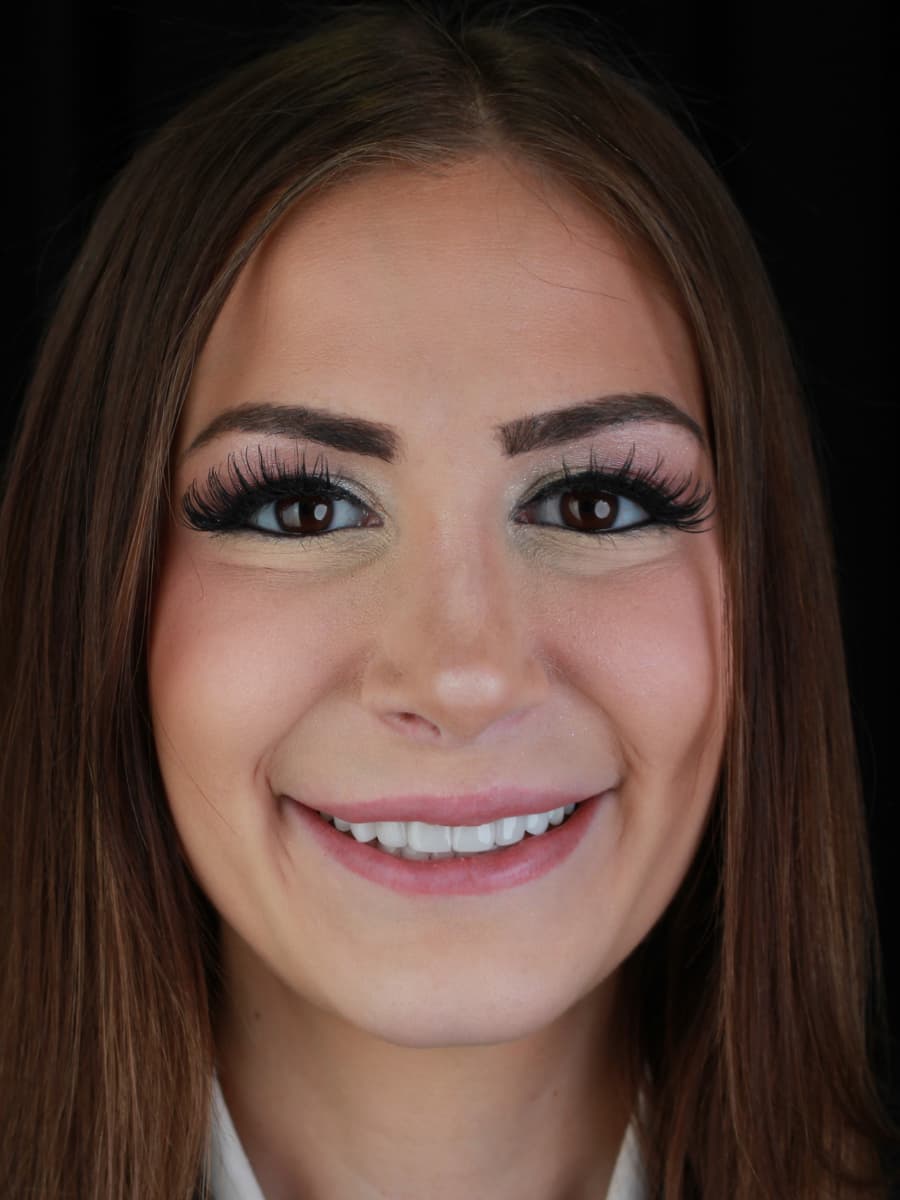 Erielle — veneer result 4